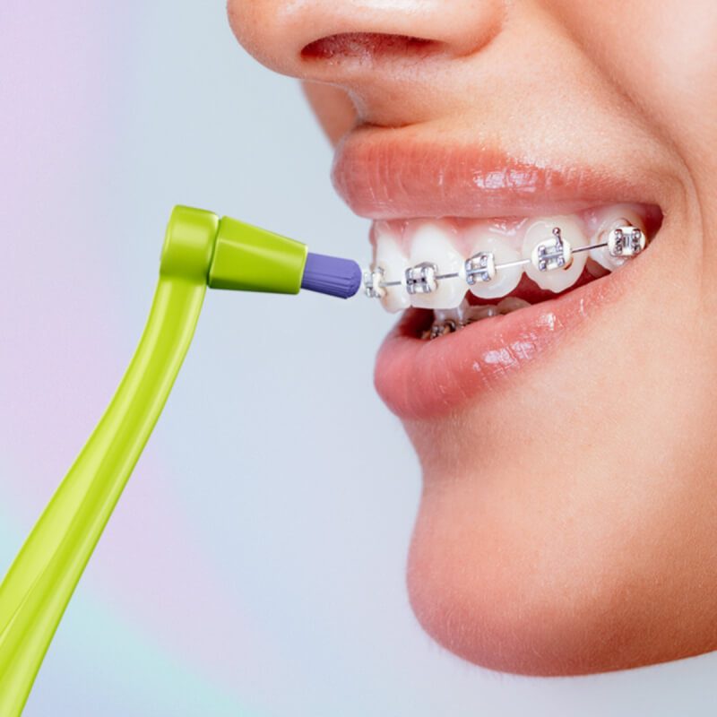 Smilex Ortho+ Single-Tuft Toothbrush with Replaceable Heads 4